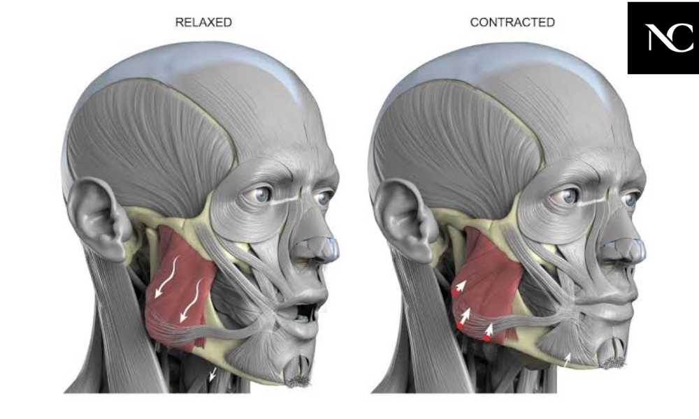masseter muscle